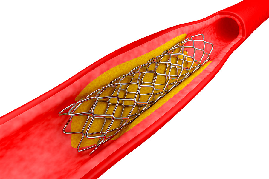 ANJİYOGRAFİ VE STENT